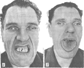 акромегалия фото