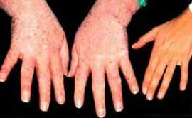 акромегалия