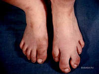 акромегалия симптомы и лечение