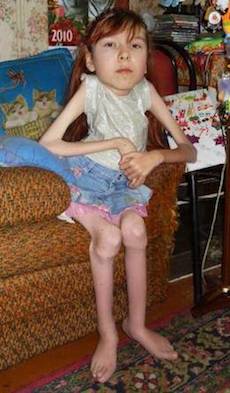 спинальная амиотрофия