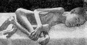 амиотрофия