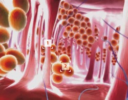 лечение целлюлита, симптомы
