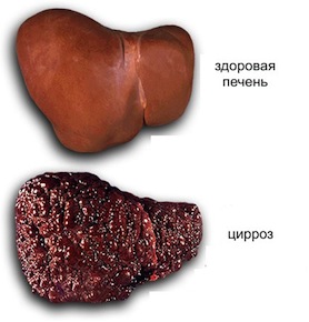 симптомы и лечение цирроза печени