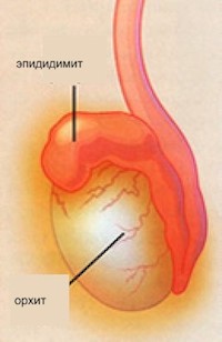 эпидидимит лечение симптомы