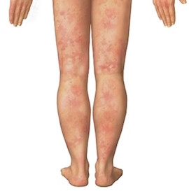 эритема фото