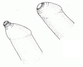 фимоз, лечение