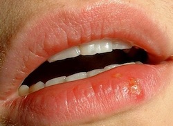 герпес на губах