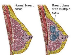 мастопатия фото