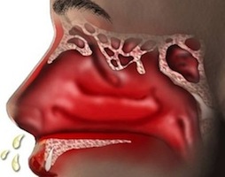 насморк лечение симптомы