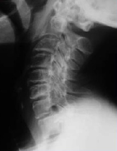 остеохондроз лечение