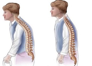 лечение остеопороза