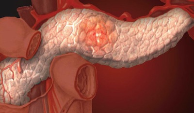 панкреатит хронический острый