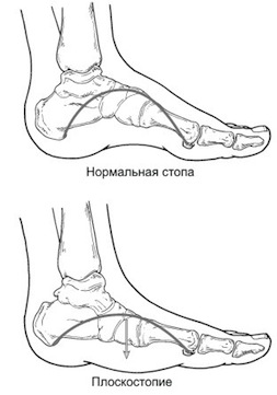 плоскостопие лечение симптомы