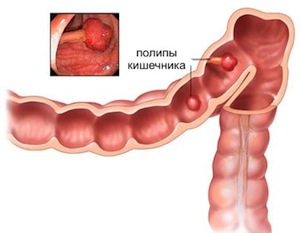 полипы кишечника симптомы лечение