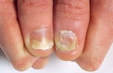 причины псориаза