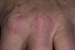 ревматические гранулемы