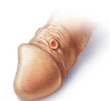 сифилис у мужчин