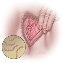 сифилис у женщин