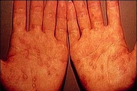 вторичный сифилис