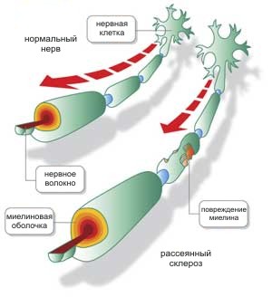 рассеянный склероз