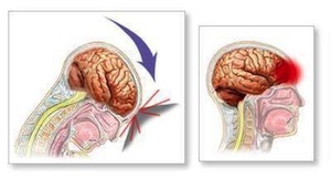 сотрясение мозга лечение