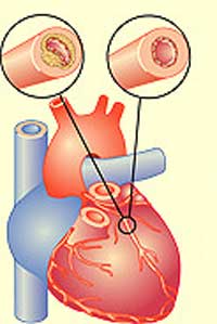 симптомы и лечение стенокардии