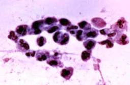 трихомониаз лечение