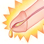 симптомы уретрита