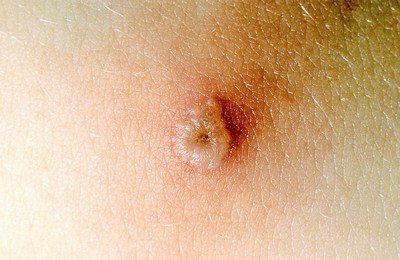 подсыхание ветрянки