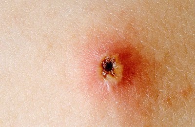 подсыхание ветрянки