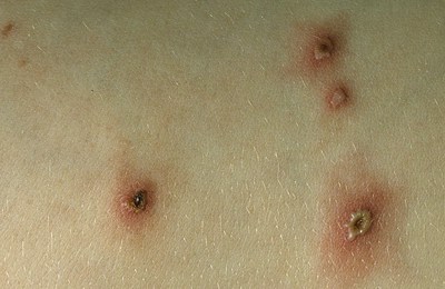 подсыхание ветрянки