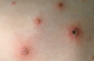 подсыхание ветрянки