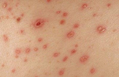 подсыхание ветрянки