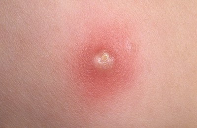 ветрянка начальная стадия