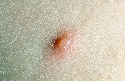 ветрянка начальная стадия