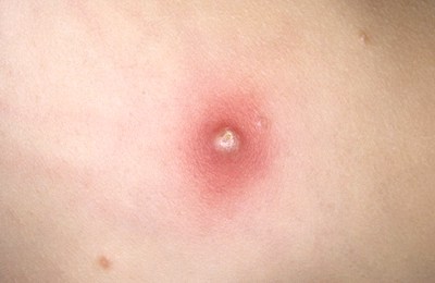 ветрянка начальная стадия