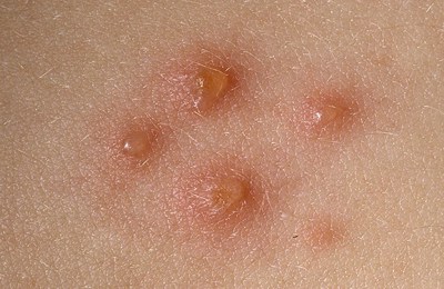 ветрянка начальная стадия