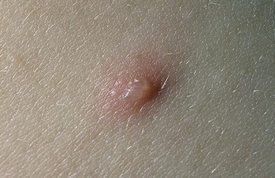 ветрянка начальная стадия