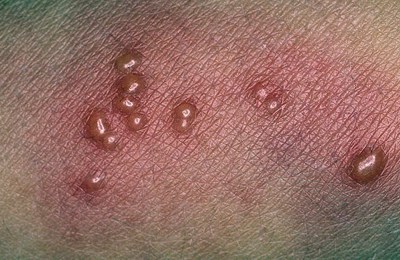ветрянка начальная стадия