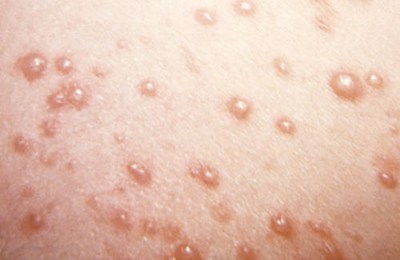 ветрянка начальная стадия