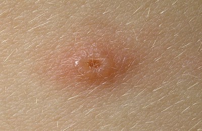 подсыхание ветрянки