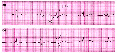 Экстрасистолия