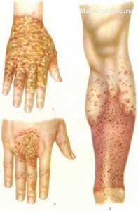 Экзема острая хроническая