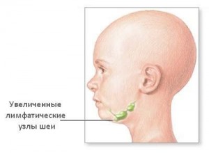неходжкинская лимфома