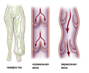 онормальная и варикозная вены