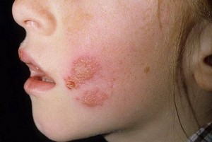 атипичная пиодермия