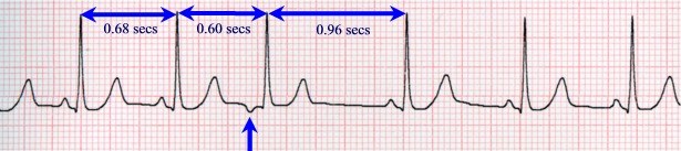 Предсердная