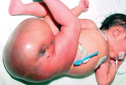 тератома новорожденного