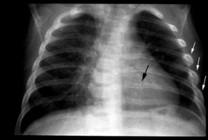 перелом ребра