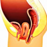 пролапс матки